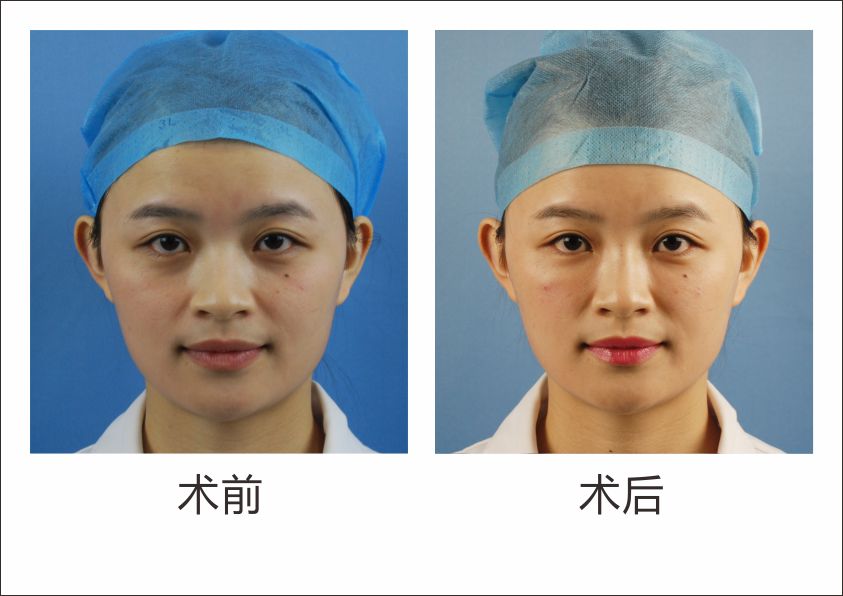 泪沟填充术_武汉艺龄整形医院